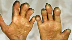 नवलपरासी पूर्वमा २८ कोष्ठरोगी उपचाररत